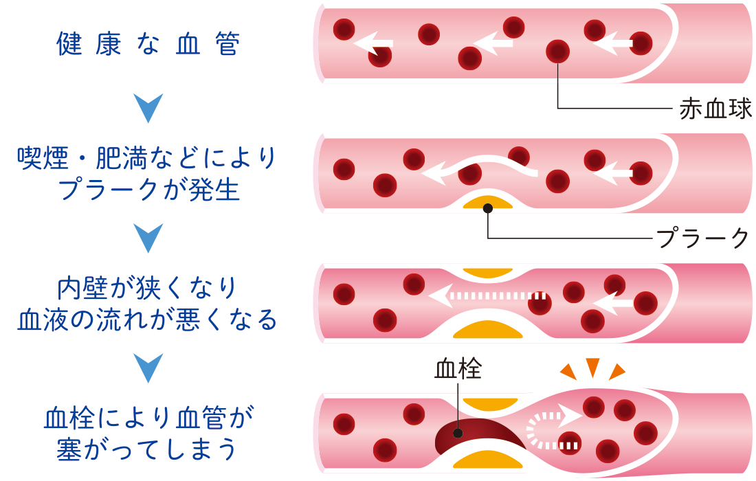 動脈硬化の発生と進行