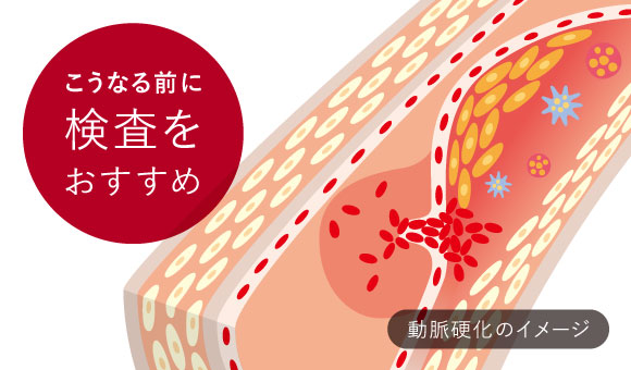動脈硬化のイメージ